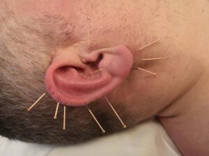 Øre akupunktur